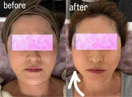 サーマトリックス（高周波）💉✨最新美容【即効小顔】DTなしで感動を◎💆‍♀️