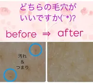 ⭐️毛穴ケア&お顔のエステ⭐️ 毛穴専用の化粧品を使用して気になる頑固な毛穴汚れを取り除きます(๑•̀ •́)و✧