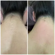 女性限定 各箇所(背中上、背中下、腕、太もも、膝下、胸、うなじ)BrazilianWAX+光脱毛