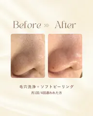 【初めての方限定】ハイドラ毛穴洗浄 1回で肌がトゥルトゥルになるのを感じられる!💖ニキビに悩んでいる方も🙆♀️
