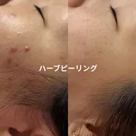 ハーブピーリング🌿