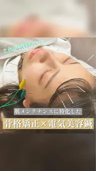 【劇的変化!】むくみ撃退美容鍼✨