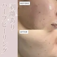 【minimoセール‼️しこりニキビ・毛穴開き・美白に✨🌿】水光肌になれる剥離ハーブピーリング💕🥚
