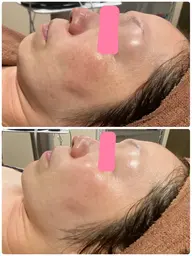 【シミ・くすみ集中ケア】光フェイシャル+カーボキシー炭酸ガスパック