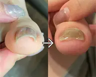 フット巻き爪プレート込みジェルネイル