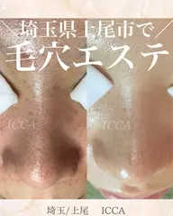 毛穴エステ