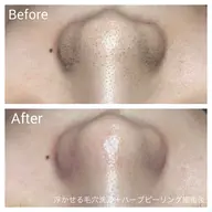 花粉での肌荒れにも❣️【シミシワ・ニキビ・毛穴・美白】肌育ハーブピーリングベーシックコース60分🌿