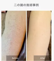 二の腕🌿ハーブピーリング【剥離あり•なし選べます】