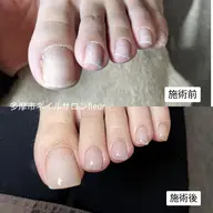 巻爪ケア親指2本+クリアージェル(オフ別途)