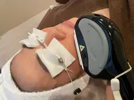 お顔の脱毛