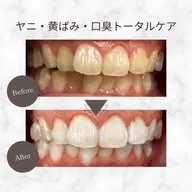 【ヤニ・黄ばみ・口臭にお悩みの方】トータルケアホワイトニング9分×3回照射