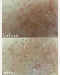 気になる毛穴悩みを一掃!スチームフェイシャル&毛穴洗浄スクライバー🫧