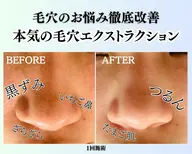 つるスベ毛穴ケア集中プラン 70分「クルーパック、毛穴引き締める美容液導入付き」