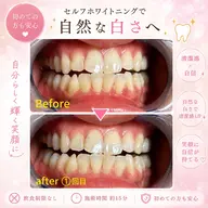 【OPEN記念モニター】セルフホワイトニング✨️ 🕒 ご予約枠10:00/12:00/14:00