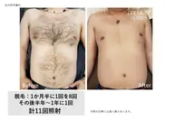 全身脱毛