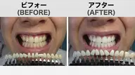 【メンズ限定】第一印象ガラッと変わる✨清潔感UPセルフホワイトニング