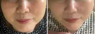 【 夕方割🌇 】 電気美容鍼➕アロマヘッドマッサージ