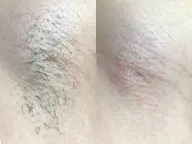 【ワキ脱毛】毛穴レスな脇を✨自信がもてる脇へ♡もう隠さないでいい脇になる!STOP🪒