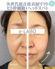 【シワ改善×速攻美肌】Lifty表層リフト+ヒト幹細胞+ドライヘッドスパ