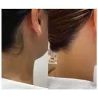 うなじWAX脱毛