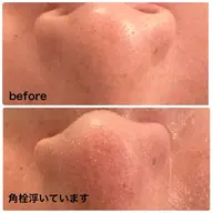 限定メニュー✨【黒ずみ毛穴洗浄×全顔導入付き】角栓ポップアップ洗浄！黒ずみ◎ざらつき◎ツルツル肌へ🌿✨