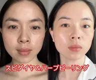 一回で驚き！✨［初回限定］韓国話題の最新美容！水光側へ✨スピダイヤ＆ハーブピーリング✨肌質改善ツヤUP 80分