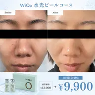 【ハリ・ツヤ・毛穴】浸透型ピーリングでコラーゲン促進🌱保湿ケアも◎エレクトロポレーション&パック付き