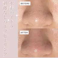 【夏限定スペシャルメニュー🌻】水素ハイドラ+剥離なしハーブピーリング+光フェイシャル💓