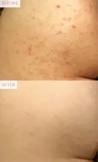 【ミニモ限定価格❤️🔥】魅せヒップケア✨剥離ありハーブピーリングで魅惑の美尻へ🍑初回¥22000→¥13000