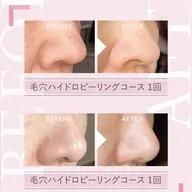 《メンズ大歓迎》韓国艶肌フェイシャル ¥8,800 → ¥4,500 ハイドロ毛穴洗浄+ヒト幹細胞