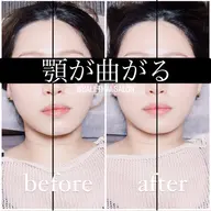 ミニモ学割＆モニター割！【顎集中】顎の左右差・高さが違う人向け体験［小顔/エラ張り/下顎骨］