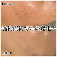 【ニキビ肌・毛穴改善】Reviハーブピーリング!効果倍増のエンザイム付き◎全顔+首