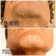 【当店人気　NO.1】　　　　　　　　　　　　　　メンズヒゲ全体脱毛