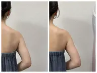 1ヶ月3回でほっそり二の腕 【レモン美容液(ボトル)使用】