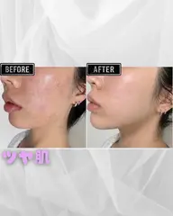 ララ越え💎最新韓国ピーリング🪄ダウンタイム無し!水光肌に導きます︎︎☁