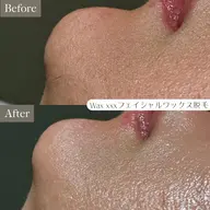 【化粧ノリUP】全顔産毛WAXでつるん肌♪wax脱毛→毛穴洗浄(鼻)→パック→お仕上げ¥17,600→¥7,700