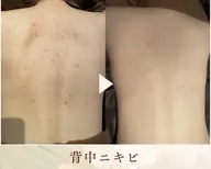 ハーブピーリング　【ボディ】