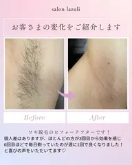 【全員/男女/自己処理によるくすみ・ポツポツに】両脇ワックス＋光脱毛¥2980
