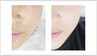【韓国で話題沸騰中!!】韓国最新美容/水光/ララピールコース初回限定¥9,800