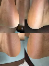 かかとケア