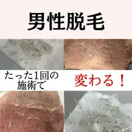 【男性人気NO.1】圧倒的抜け感!脱毛期間もツルツルが続く〈ひげ脱毛〉¥2000