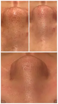 毛穴気になる方はこれ!!毛穴レスケア✨️