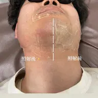 メンズ 髭脱毛(モニター)