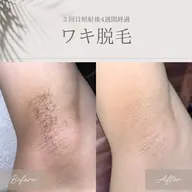 【9月限定！先着10名様500円✨】脇脱毛モニター