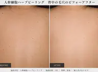 【ボディ1部位】＜剥離なし＞ヒト幹細胞ハーブトリートメント