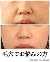 ハーブピーリング🌿剥離なし!毛穴、シミ、シワ・たるみなどエイジングケアに最適♪