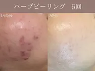 【ニキビ・毛穴ケア】ハーブピーリング 〈月3名限定〉