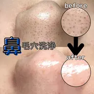 特別価格✨️🍓同時施術可能🍓【鼻だけ!👃毛穴洗浄💧】⏰45分