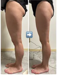 脚のむくみとサヨナラ！ラジオ派で温めながら脚全体、お腹のむくみやセルライトを刺激【体験版】