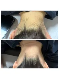 うなじワックス脱毛